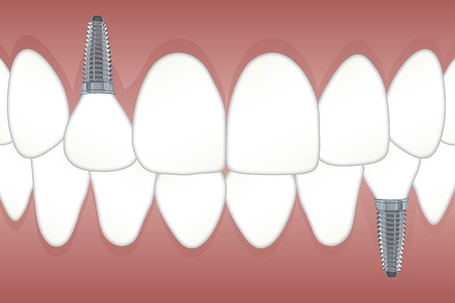 implantes dentales en alicante
